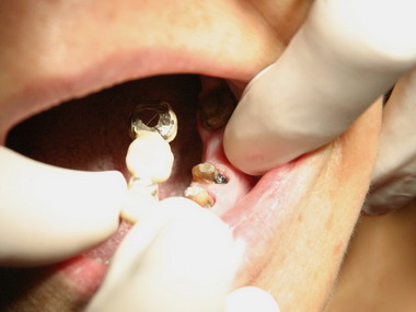 使用劣質金屬假牙  小心牙齒病變(圖)