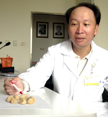 老翁排尿困難 膀胱結石成串珠(圖)