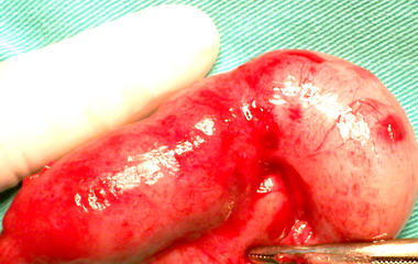 10歲童擁巨盲腸投醫割除好安眠(圖)