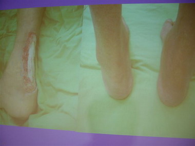 用人工真皮取代皮瓣(圖)