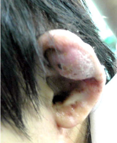 路邊穿耳洞感染 耳朵變小菜花(圖)