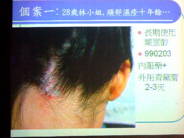 十年濕疹埋頭皮  中藥調理脫困(圖)