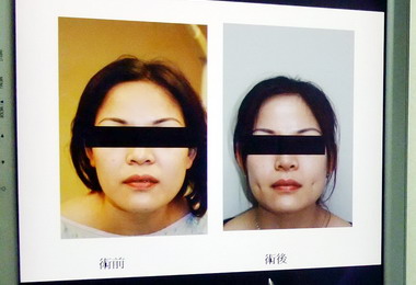 越籍新娘做人工酒窩增添個人魅力(圖)