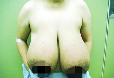台中孕婦妊娠巨乳症乳房脹如冬瓜(圖)