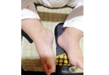 腸病毒活躍期居家小心相互傳染(圖)