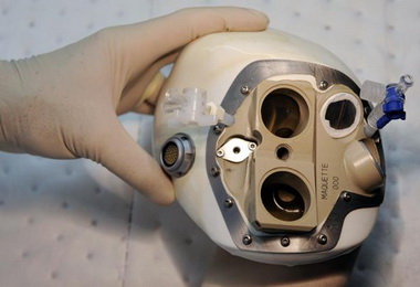 全球首例移植人工心臟法國達陣(圖)