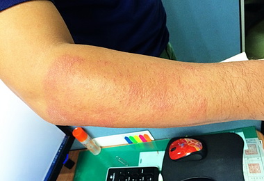 怕冷戴口罩 易發接觸性皮膚炎(圖)