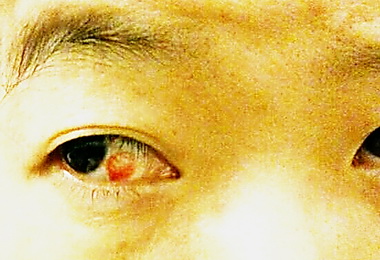 咳嗽咳到眼睛出血 投醫：莫驚慌(圖)