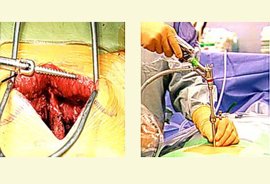 投醫：脊椎開刀進化微創手術復原快(圖)