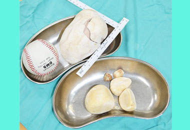 結石10年 手術取出兩個棒球大(圖)