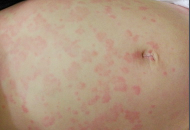 孩子亂吃小心蕁麻疹找上門(圖)