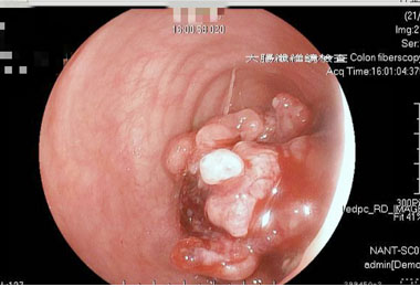 便秘易頭暈 小心大腸癌找上門(圖)