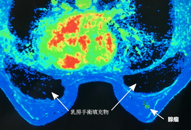 整形過 可透過核磁共振檢查乳癌(圖)