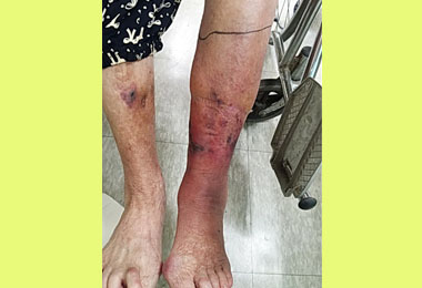 遭竹子刺傷 老婦患蜂窩性組織炎(圖)