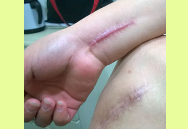 氣滯血瘀導致蟹足腫針灸消腫(圖)