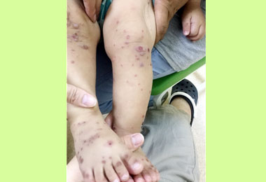 秋老虎續發威腸病毒不減反增威力(圖)