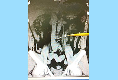 男子胃痛就醫 竟查出尿路結石(圖)