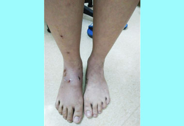 忽視小傷口戲水男童腳腫如麵龜(圖)