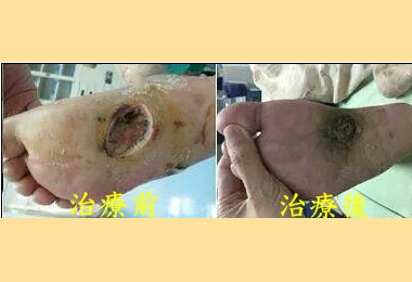 腿傷久不癒險截肢醫護悉心照顧保住(圖)