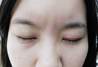 過期食物吃下肚小心蕁麻疹上身(圖)