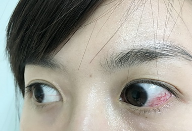 上鞏膜炎致紅眼 醫：多數能自癒(圖)