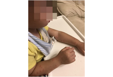 地毯玩耍幼童感染膿痂疹(圖)