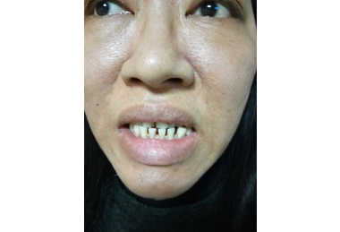 肢端肥大症 籲提早治療(圖)