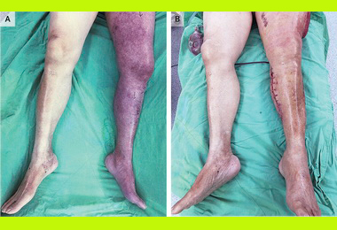 高醫內外科團隊聯手搶救靜脈血栓紫腿(圖)