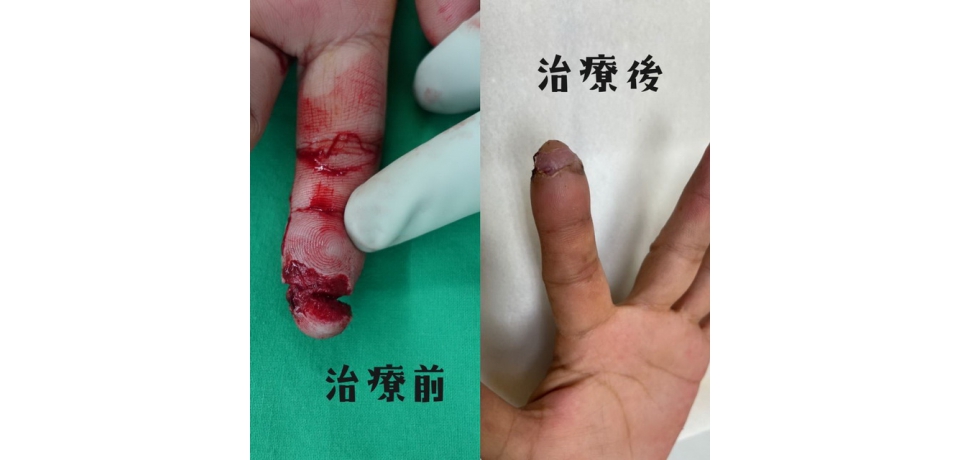 工廠斷指風險高 顯微重建手術助重生(圖)