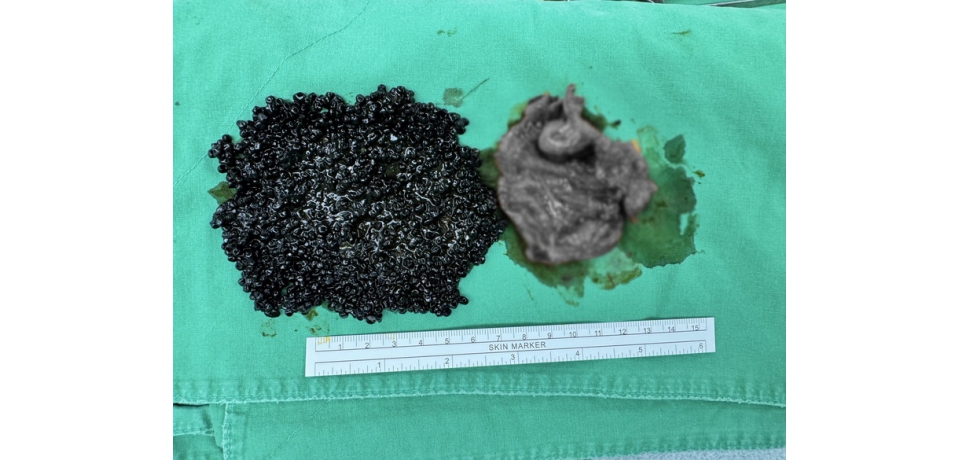 輕熟女大啖火鍋後喊腹痛 醫驚見「魚子醬」狀結石塞爆膽囊(圖)